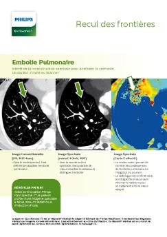 Recul des frontières - Philips
